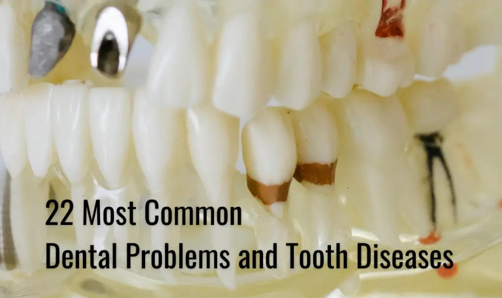 Dental Problems and Tooth Diseases