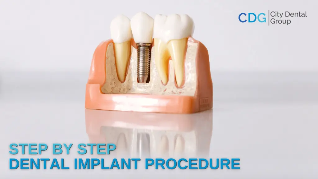 Steps of the Dental Implant Process