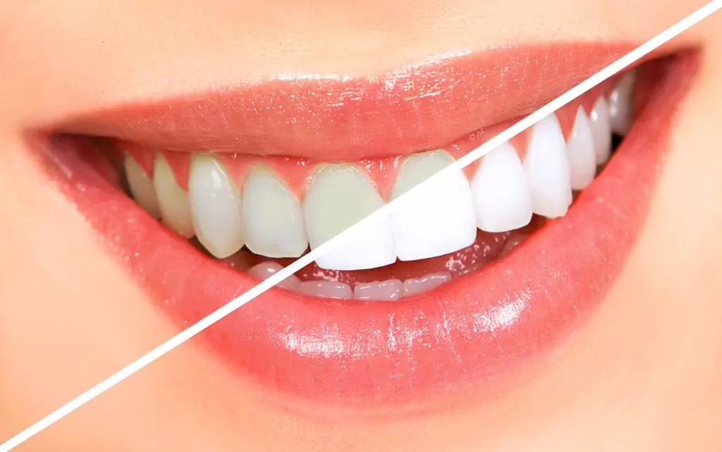 reduce sensitivity after teeth whitening