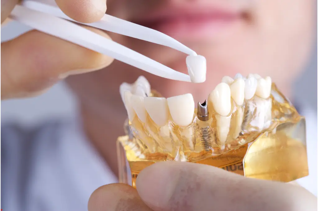 What are Dental Implants?