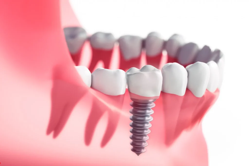 Dental Implants Lower Manhattan NYC