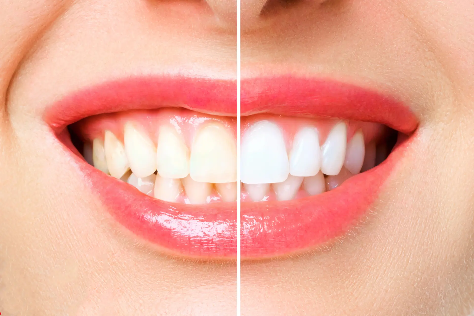 Teeth Whitening Lower Manhattan New York