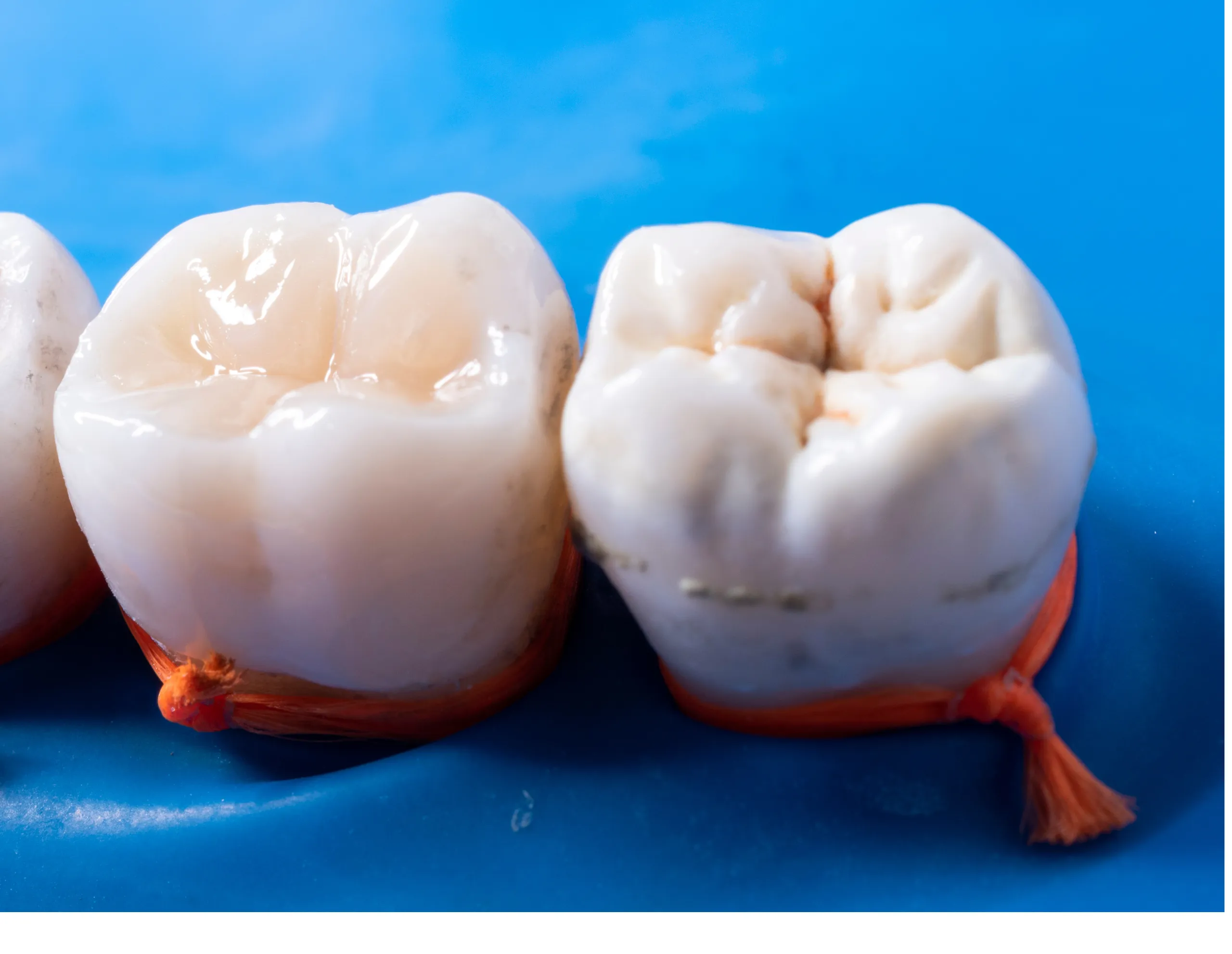 What Are Dental Sealants