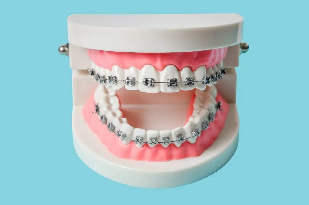 Cosmetic Braces