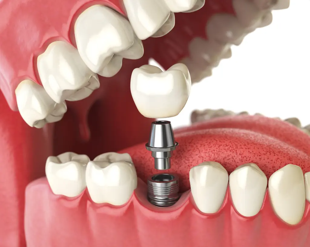 Dental Implants