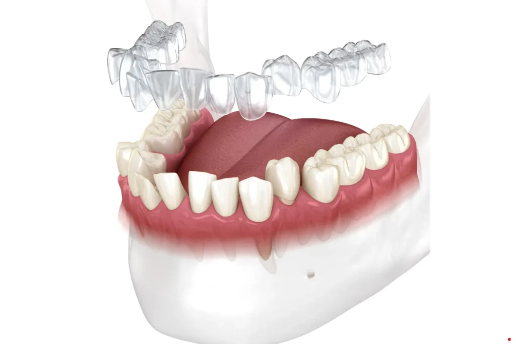 Invisalign