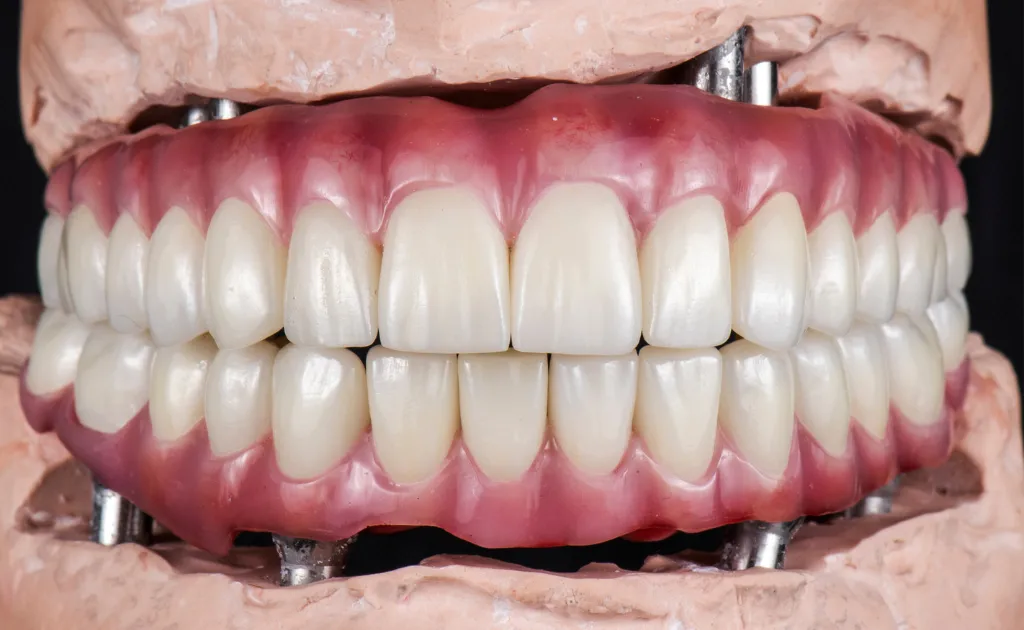 All-On-4 Full Mouth Implants