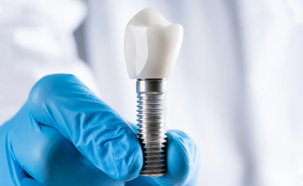 Single Tooth Implants & Bridges