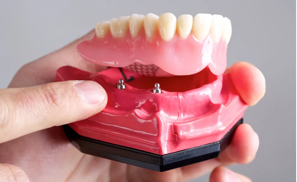 Snap-In Implant Dentures