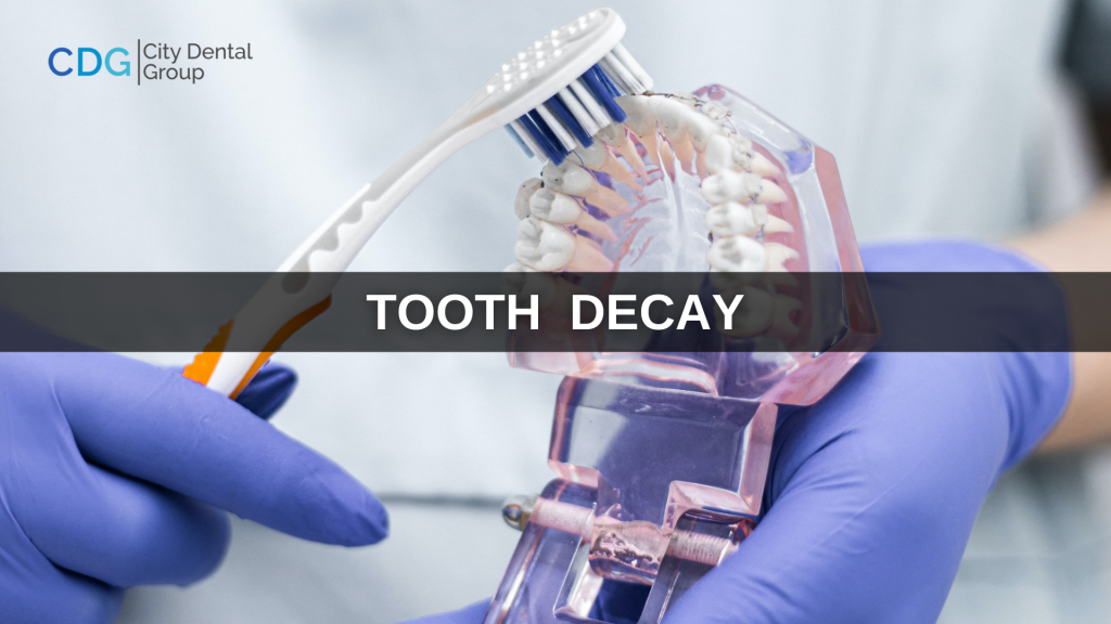 How To Prevent Tooth Decay Tooth Decay Treatment At Home