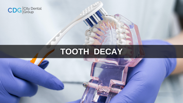 tooth decay treatment & prevention