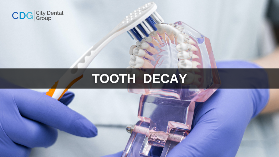 How To Prevent Tooth Decay Tooth Decay Treatment At Home