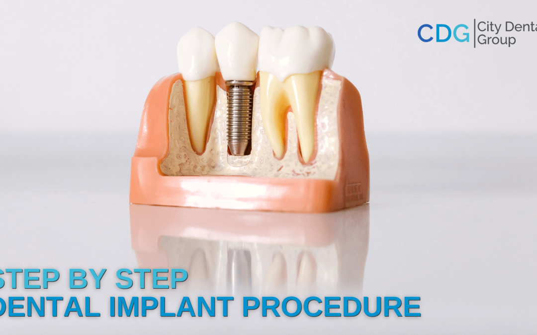 Step By Step Dental Implant Procedure