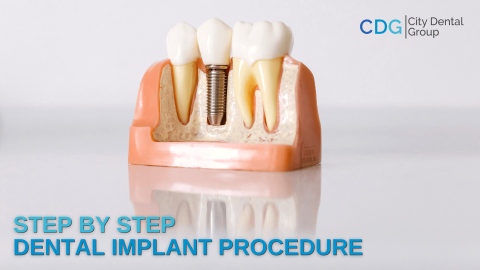 Complete Step By Step Dental Implant Procedure