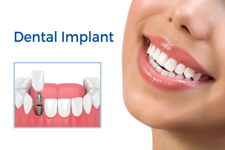 Dental implants and how it can affect your jaw health positively