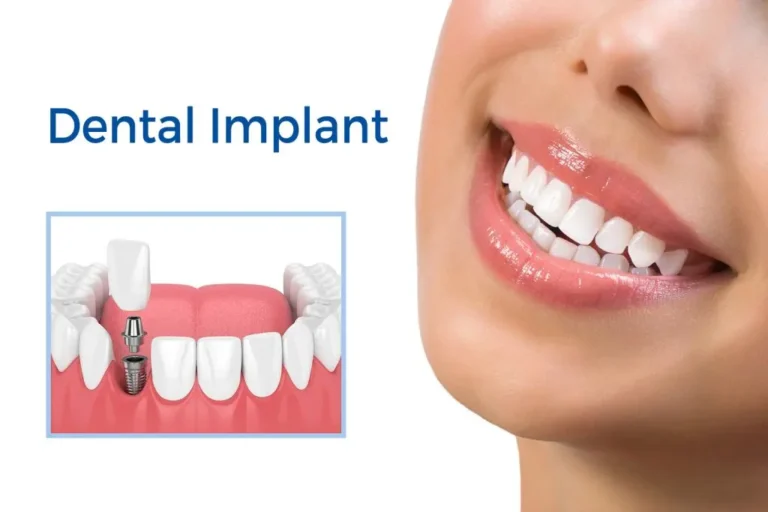 Dental Implants Support Jaw Bone Health