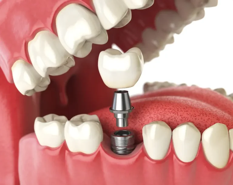 Which Dental Specialist Does Implants?